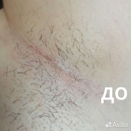 Электроэпиляция
