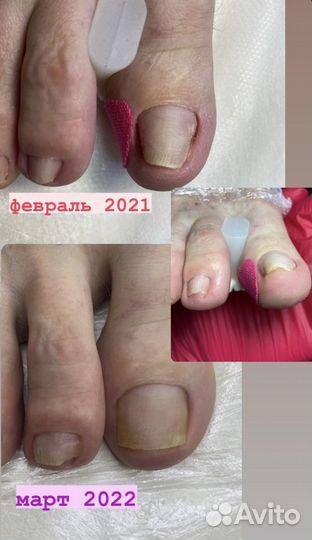 Педикюр подологический (мужской, женский)