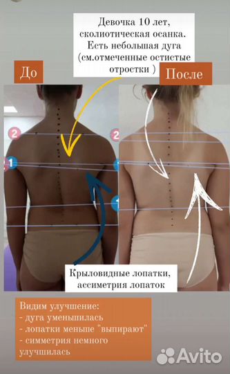 Коррекция осанки, лечение сколиоза, плоскостопие