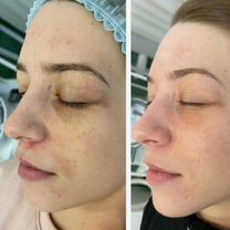 Пилинг лица/ желтый пилинг/ мезопилинг