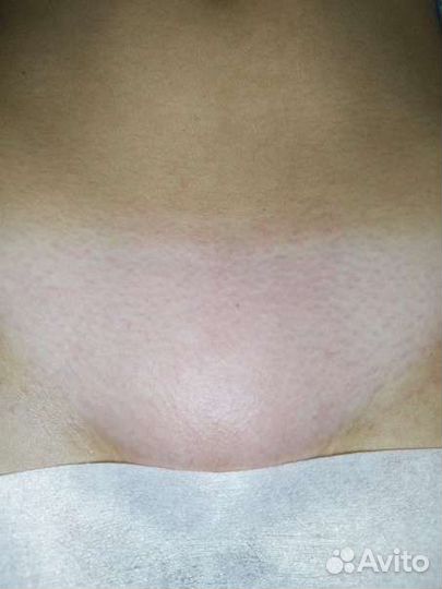 Шугаринг, депиляция