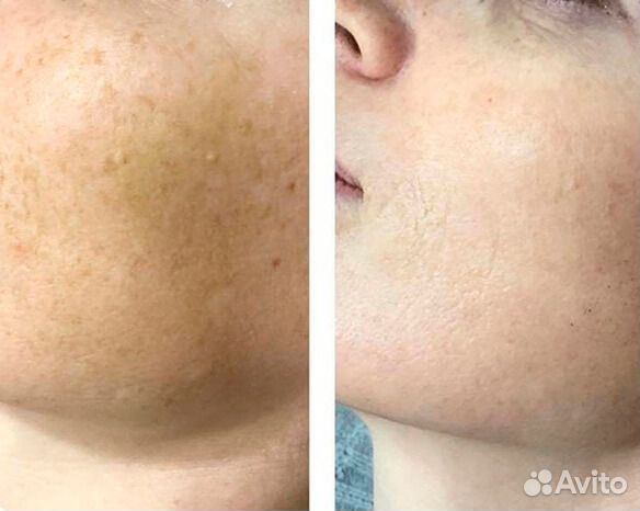 От пигментации крем Ингибитор. Мирра