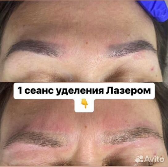 Удаление татуировок лазером