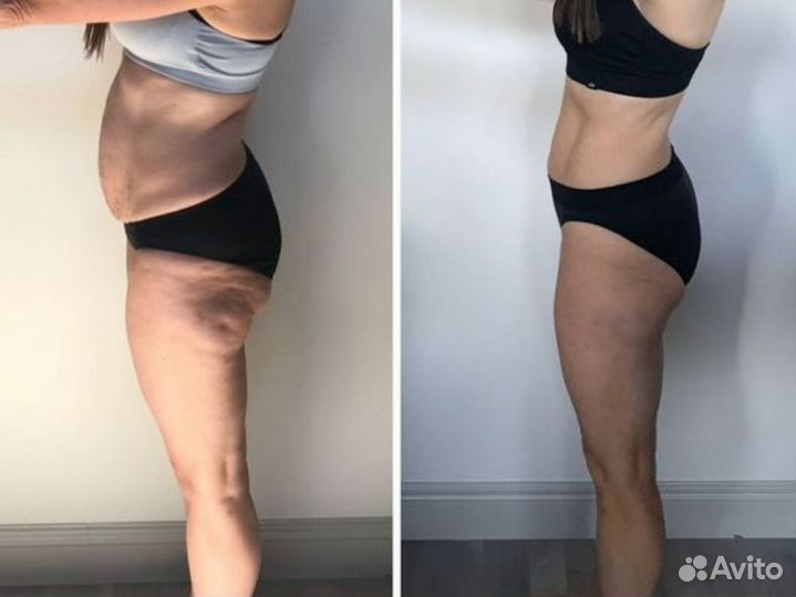 Антицеллюлитный массаж, коррекция фигуры