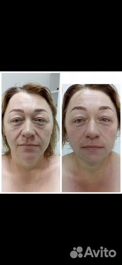 Скульптурный массаж лица