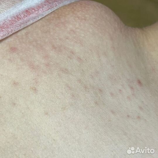 Электроэпиляция