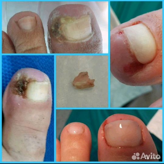 Медицинский педикюр