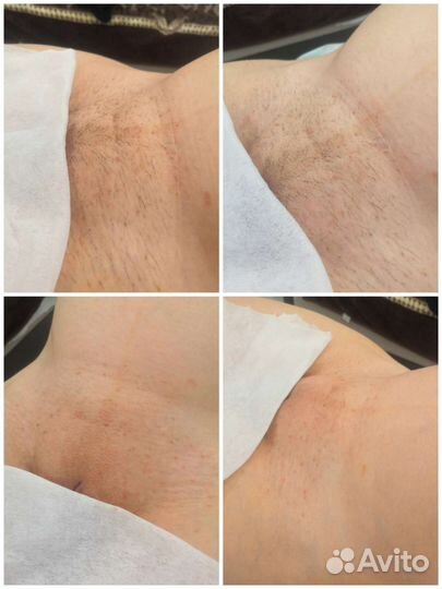 Шугаринг: подмышки