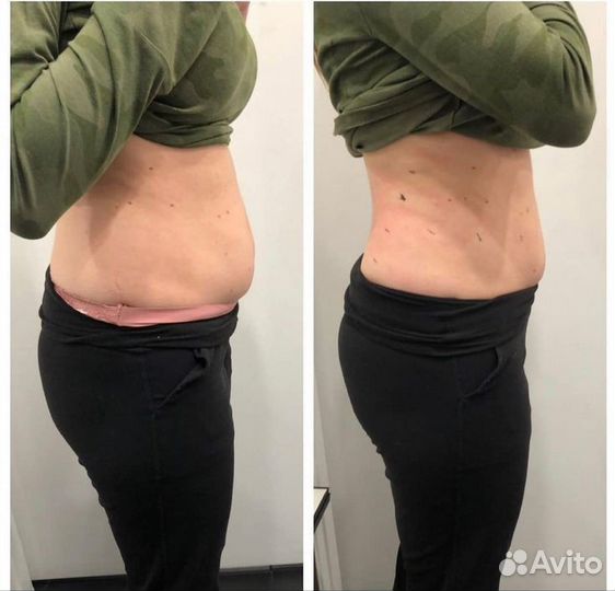 Аппаратный массаж