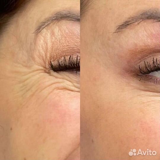 Коррекция морщин. Ботокс