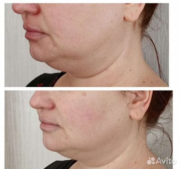 СМАС лифтинг