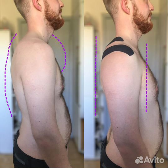 Тейпирование