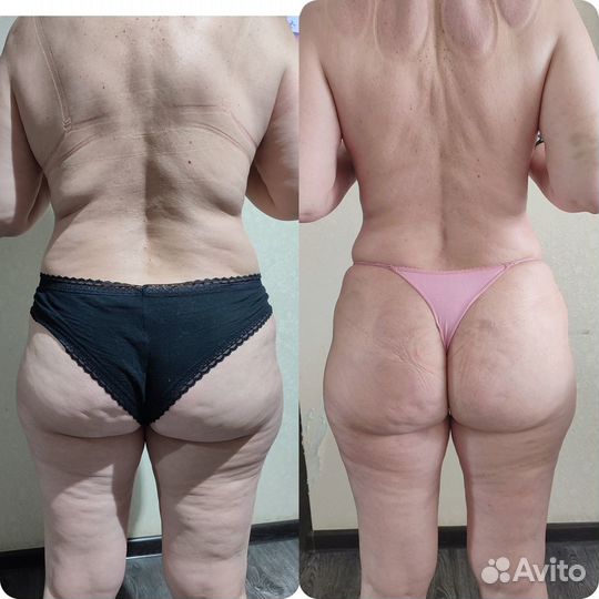 Массаж. Антицеллюлитный массаж. Коррекция фигуры