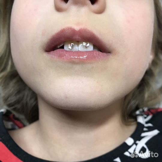 Установка скайсов