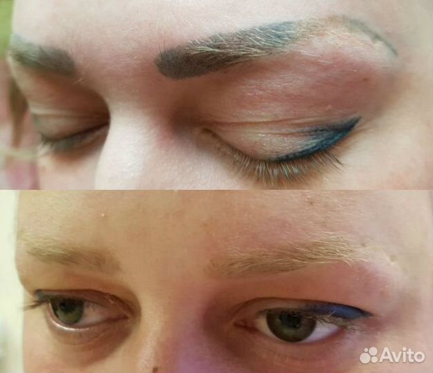 Удаление татуажа перманентного макияжа