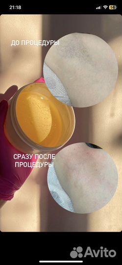 Шугаринг депиляция