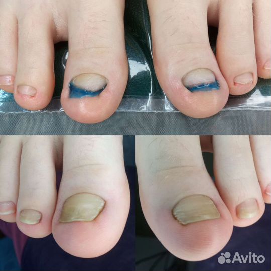 Титановая нить, Коррекционный педикюр