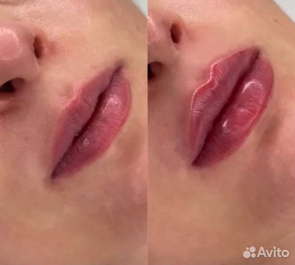Увеличение губ