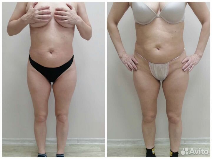 LPG массаж vela Shape