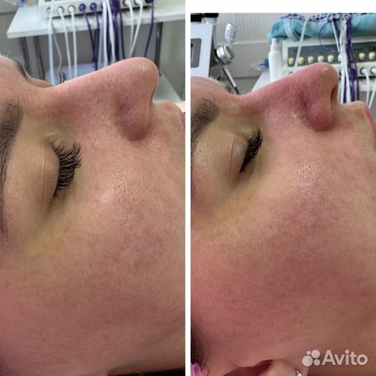 Комбинированная чистка лица, уходовые процедуры