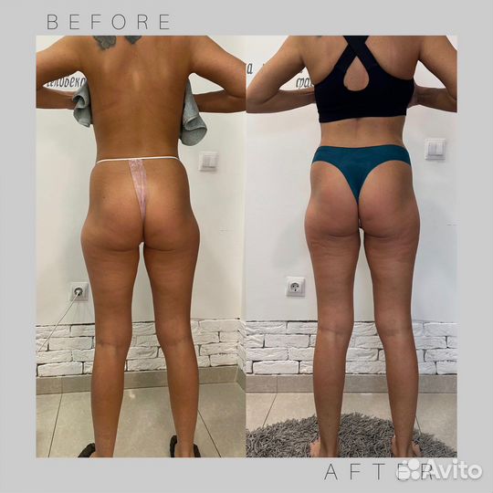 Коррекция фигуры