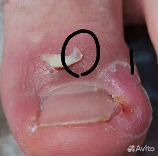 Медицинский педикюр подолог