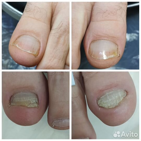 Педикюр, подолог