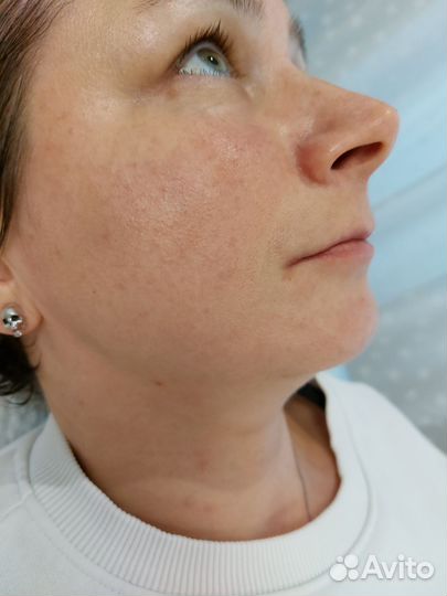 Массаж лица/Пилинг/Мезотерапия /Чистка лица