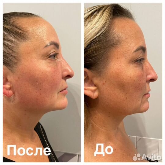 Скульптурный массаж лица