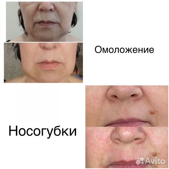 Безоперационная блефаропластика