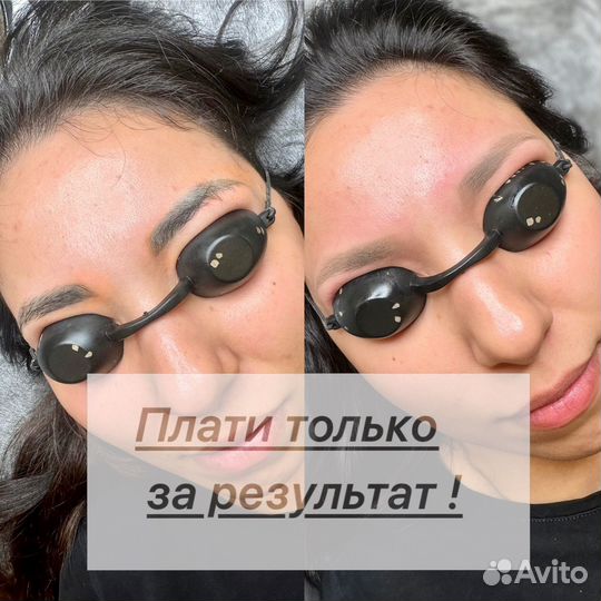 Лазерное удаление татуажа пикосекнудным лазером