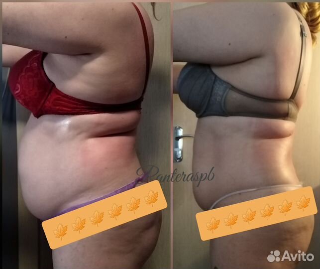 Модель на криолиполиз