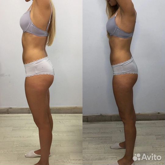 Аппаратное похудение EmsCulpt