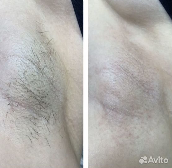Электроэпиляция