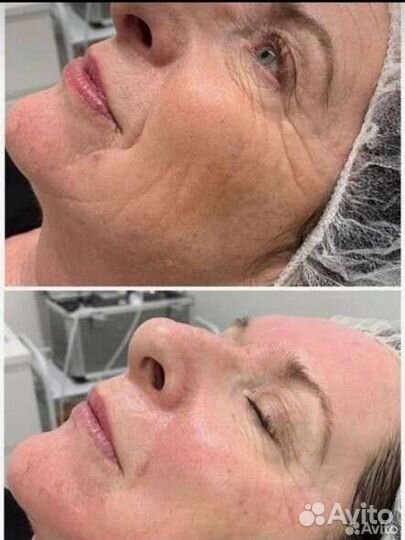 Биоревитализация лица