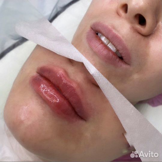Увеличение губ