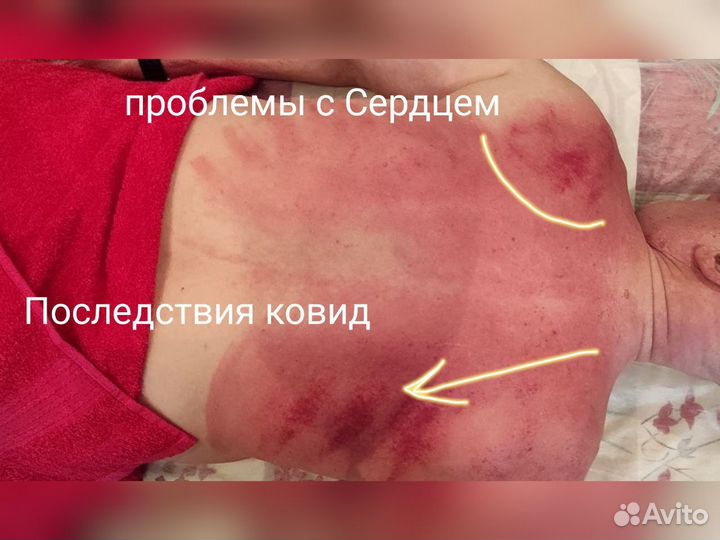 Массаж гуаша