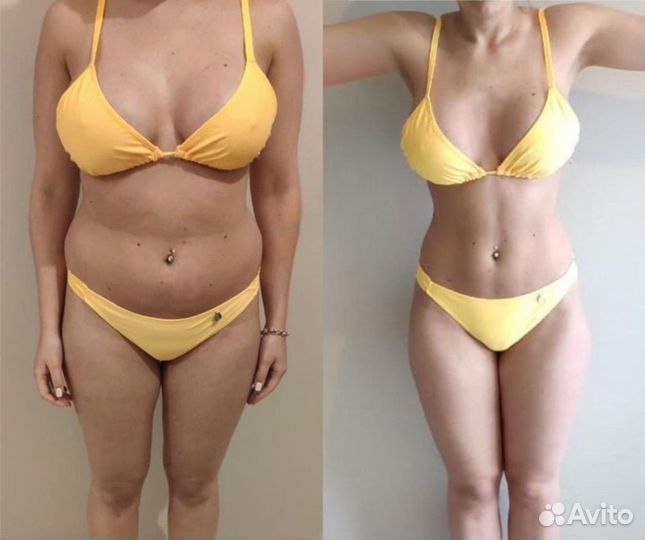 Массаж LPG - целлюлиту бой