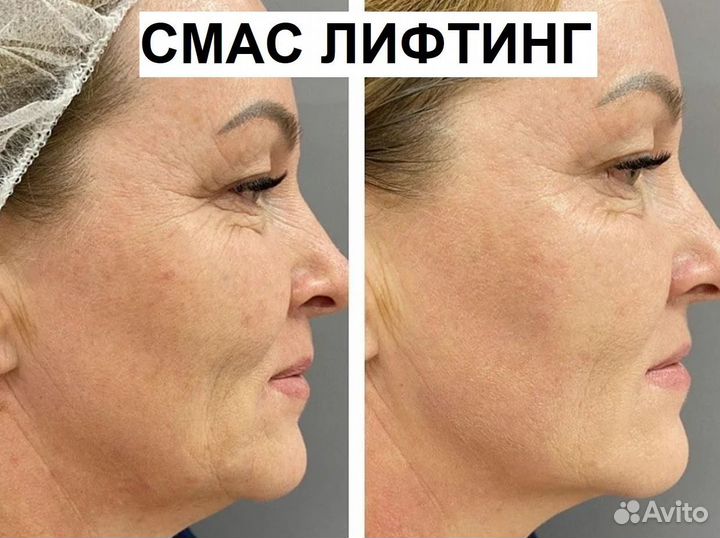 Минус 7 лет на лице