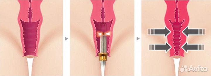 Интимное омоложение, подтяжка, интимная пластика