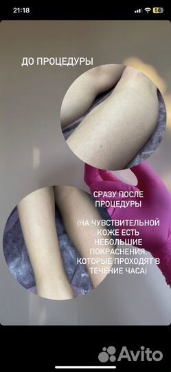 Шугаринг депиляция
