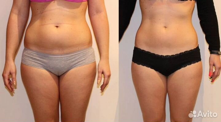 Услуги кавитации/Кавитация