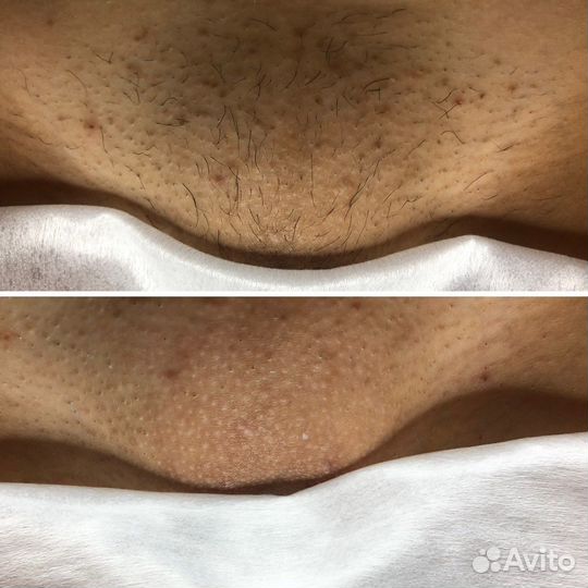 Депиляция воском: глубокое бикини