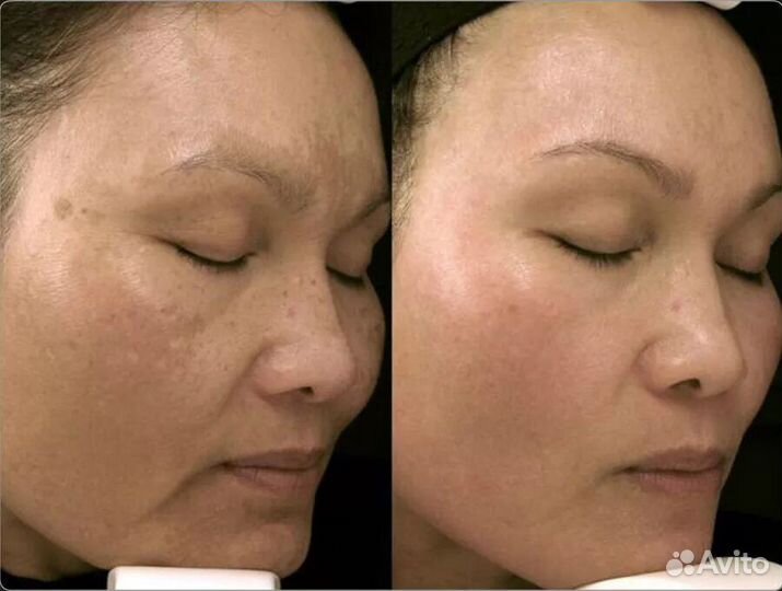 Всесезонный омолаживающий карбоновый пилинг