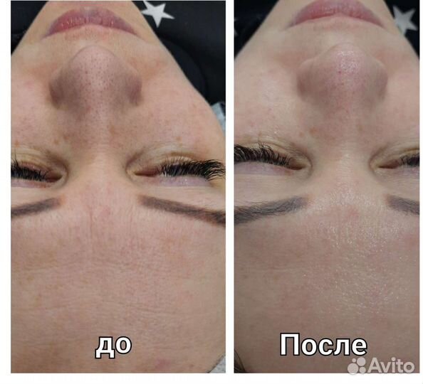 Голливудская чистка лица