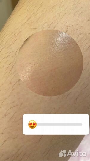 Восковая депиляция, шугаринг