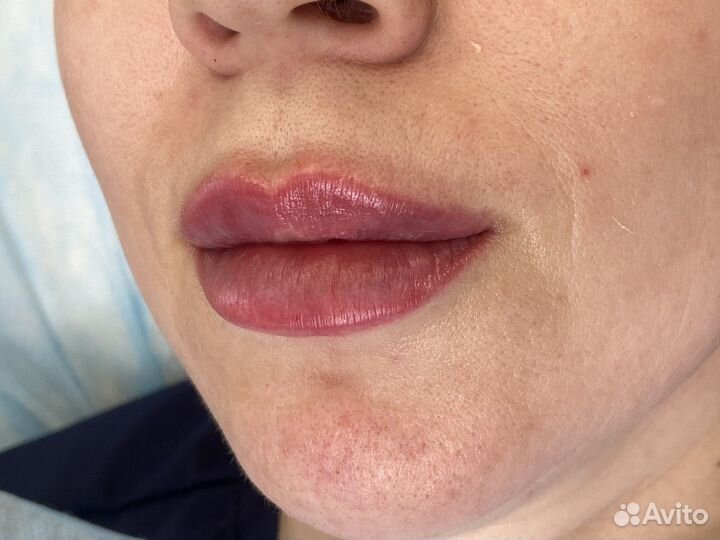 Увеличение губ, косметолог