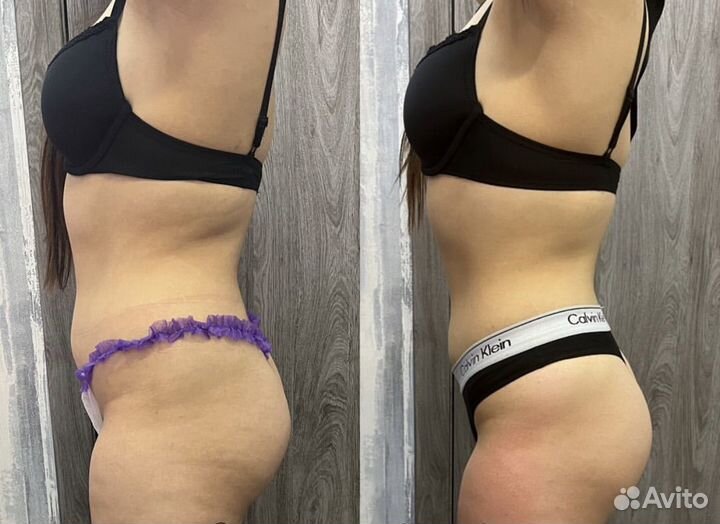 Антицеллюлитный массаж с эффектом сразу