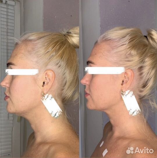 Карбокситерапия