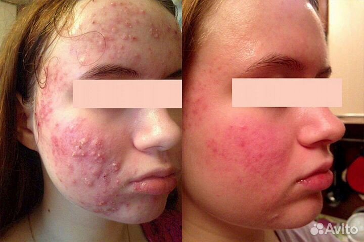 Лечение акне аппаратом навсегда